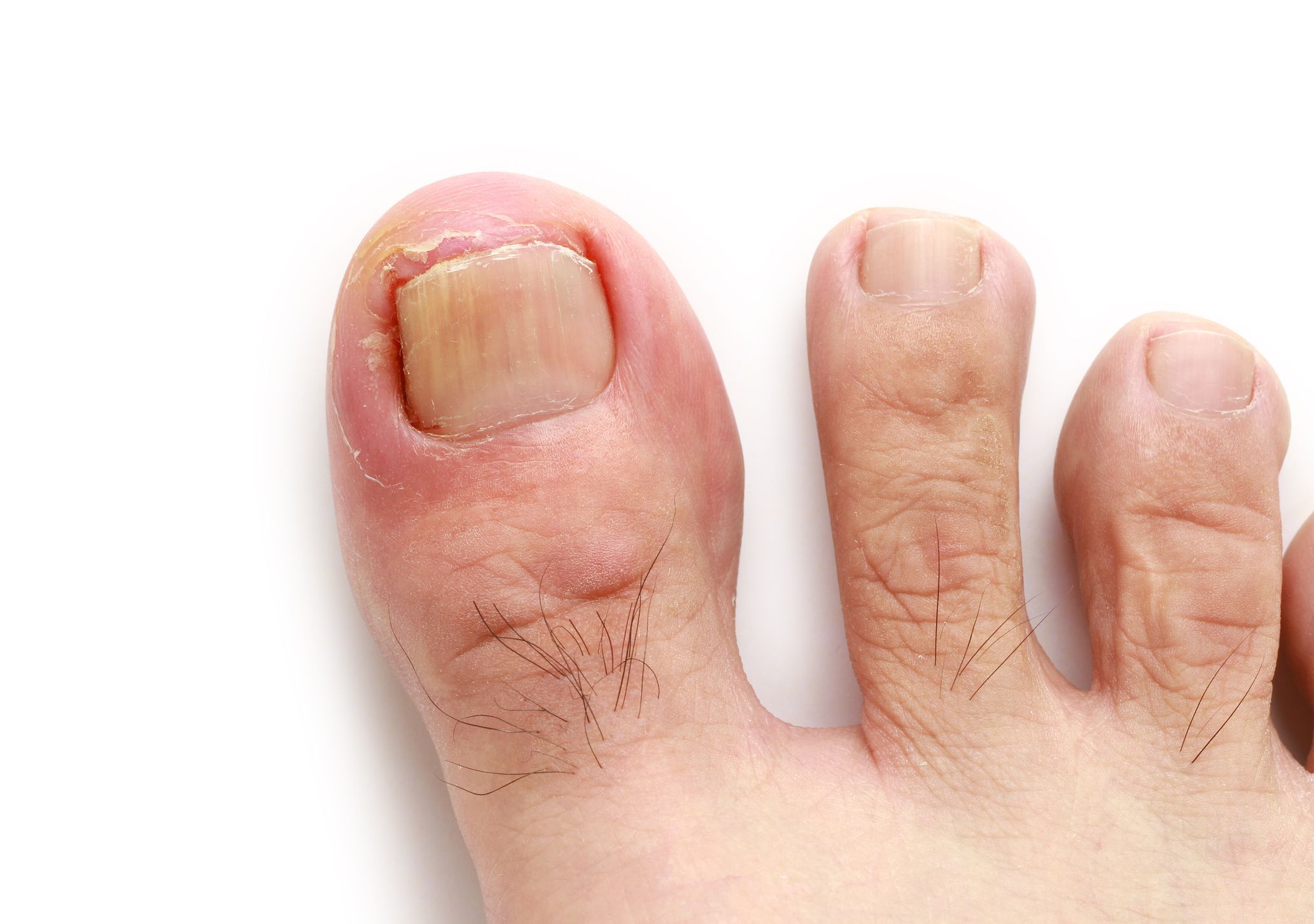 ingrown toenail treatment in Cardiff